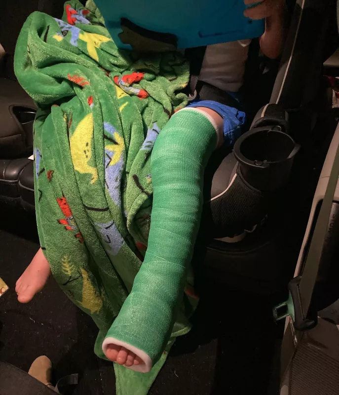 Close-up of Eli Breitbach's broken leg