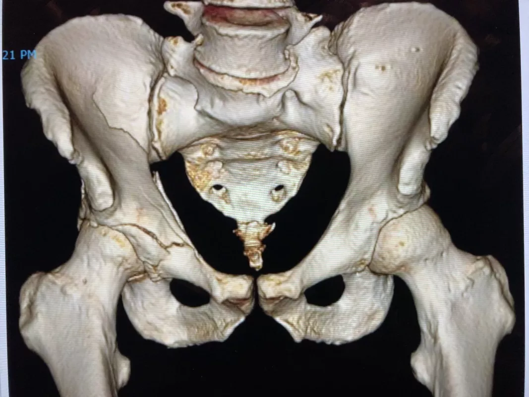 Woodward's hip injury xray