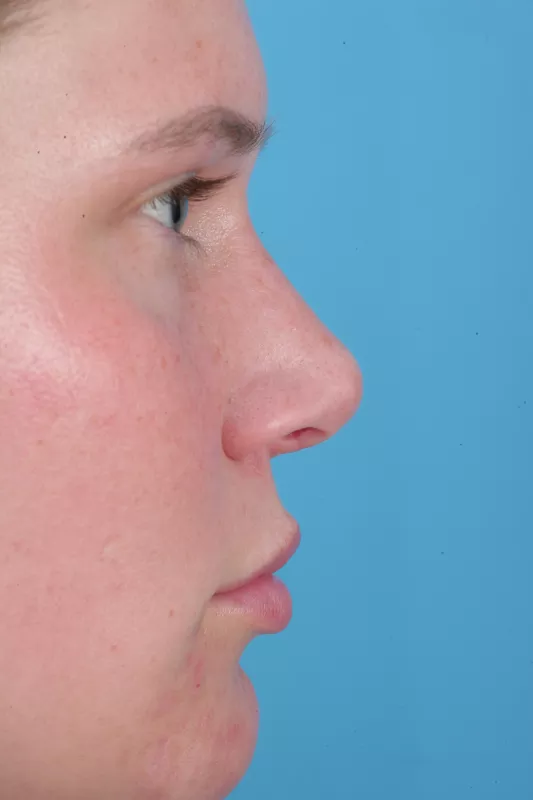 Side image of after nose surgery
