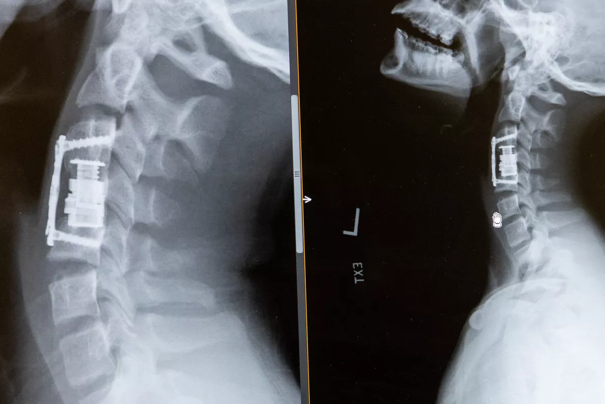 X-ray of a fourth vertebra in a cervical spine (C4), or neck region