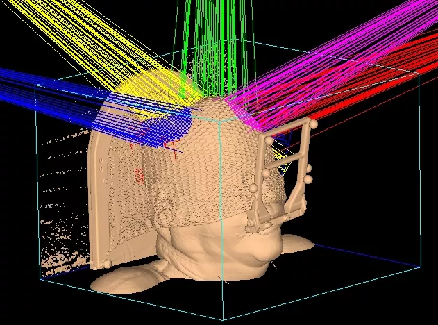 Stereotactic radiosurgery (SRS)