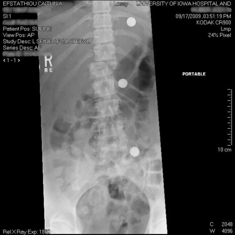 Caitlin Efstathiou sustained numerous injuries, including a broken back, after a car accident in 2009. 