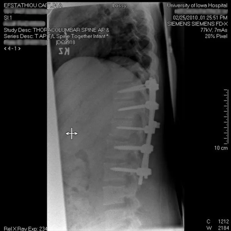 Caitlin Efstathiou sustained numerous injuries, including a broken back, after a car accident in 2009. 