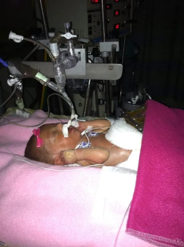 Kid Captain Lily Sebastian as a baby with tubes in nose in the NICU