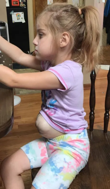 Kid Captain Lily Sebastian as a child sitting at a table with Omphalocele showing at her stomach
