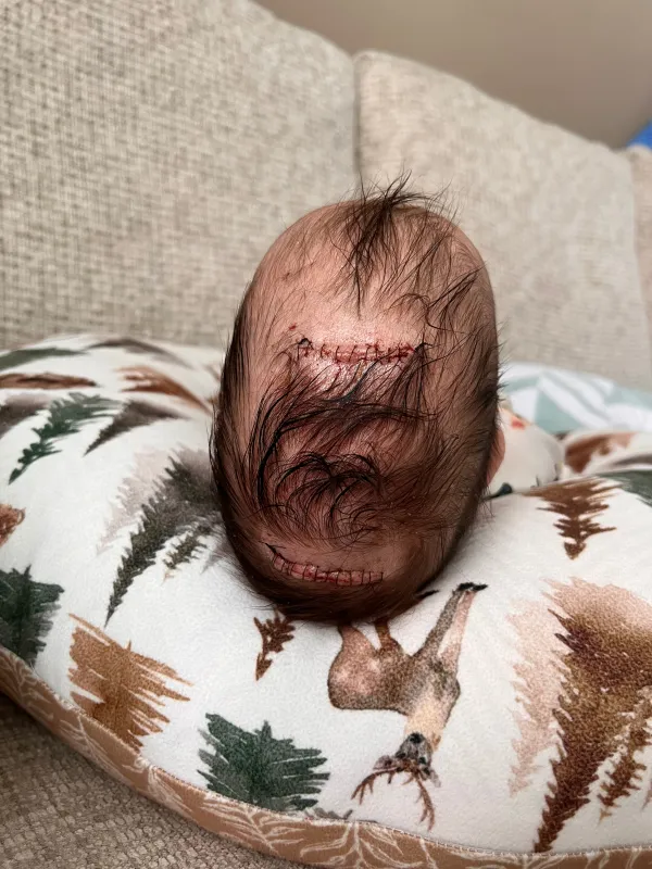 Top down view of Bodhi's head and incisions.