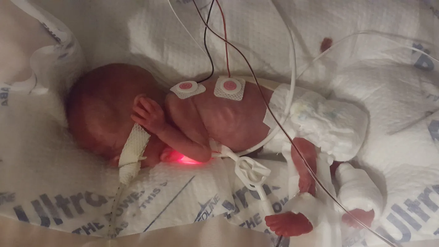 Kid Captain Eliana Gaul as a premature infant