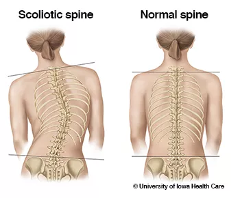 Diagram of scoliotic spine and a normal spine