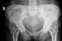 X-ray of a Hip Fracture