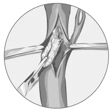 Medical illustration of a pulmonary thromboendarterectomy