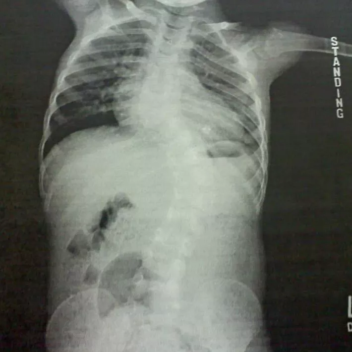 Ayden's scoliosis x-rays