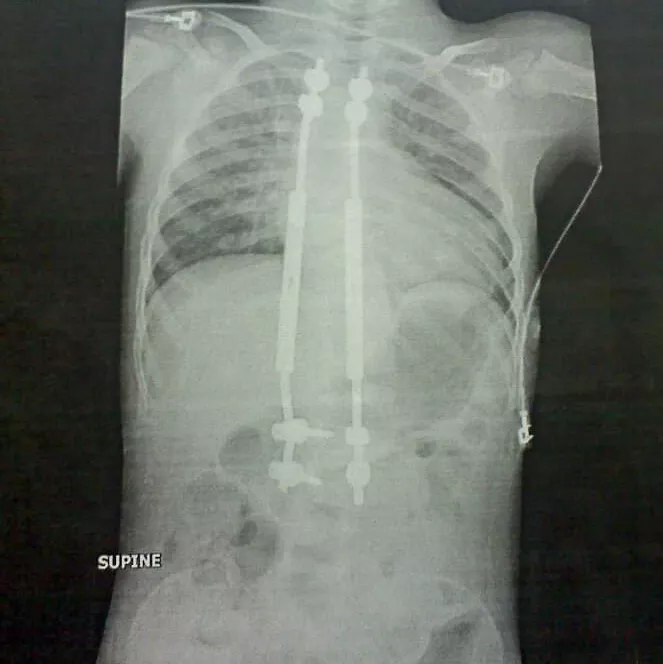 Ayden's scoliosis x-rays with rods