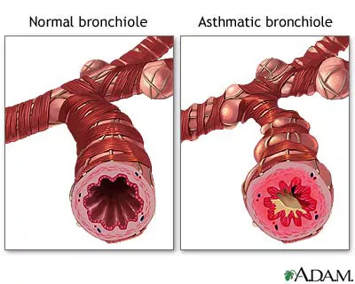 Image of a normal bronchiole and an asthmatic bronchiole