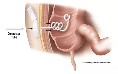 Cecostomy with connector tube