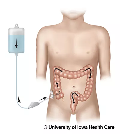 Cecostomy tube care procedure