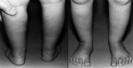 Figure 3 Clubfoot