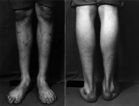 On the cure of club-foot without cutting tendons : and on certain