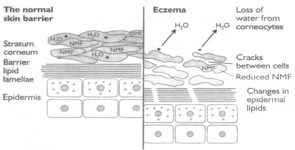 Image of a normal skin barrier compared to eczema