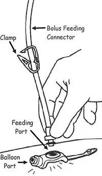 G-Button Bolus Feeding Connector