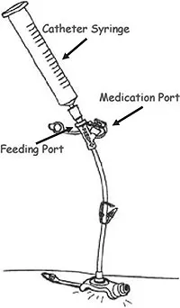 G-Button Catheter Syringe and Ports
