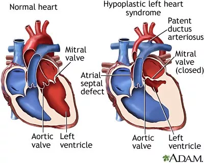 hypoplastic left heart