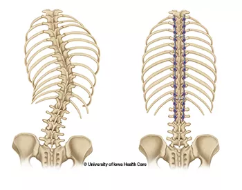 Posterior spinal fusion illustration of before and after