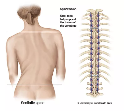Scoliotic spine and an illustration of steel rods