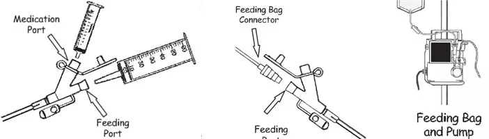 Peg tube feeding bags hot sale