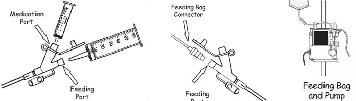 Using Your PEG Tube drawings of feeding