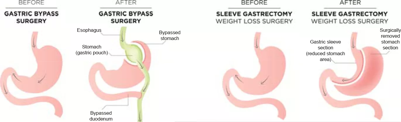 Illustration of gastric bypass and sleeve gastrectomy surgeries