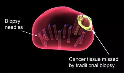 MRI ultrasound fusion biopsy technology drawing