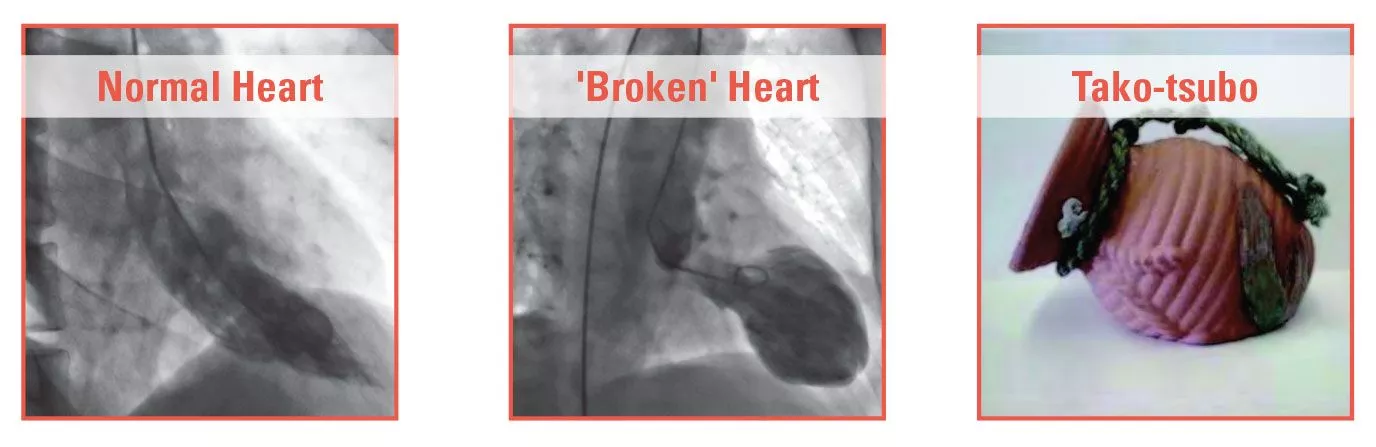 broken heart syndrome images
