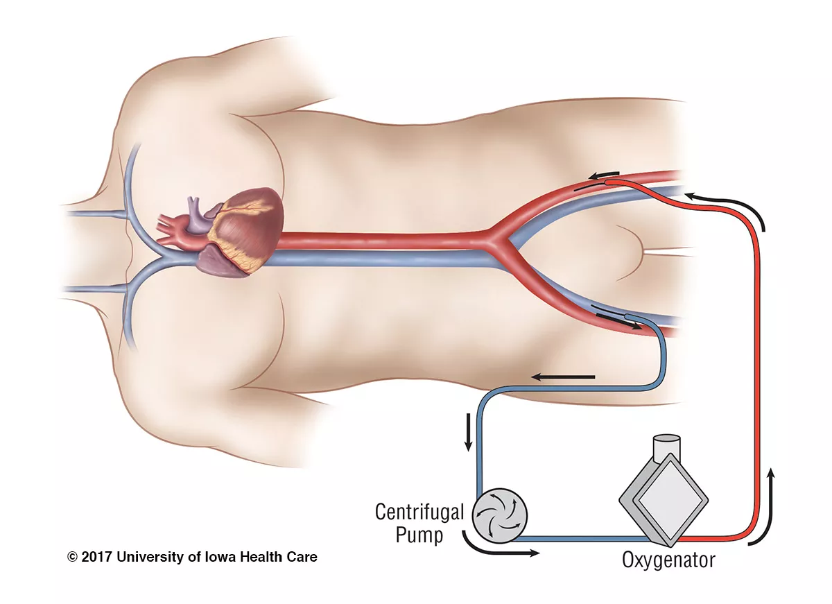 open chest ecmo