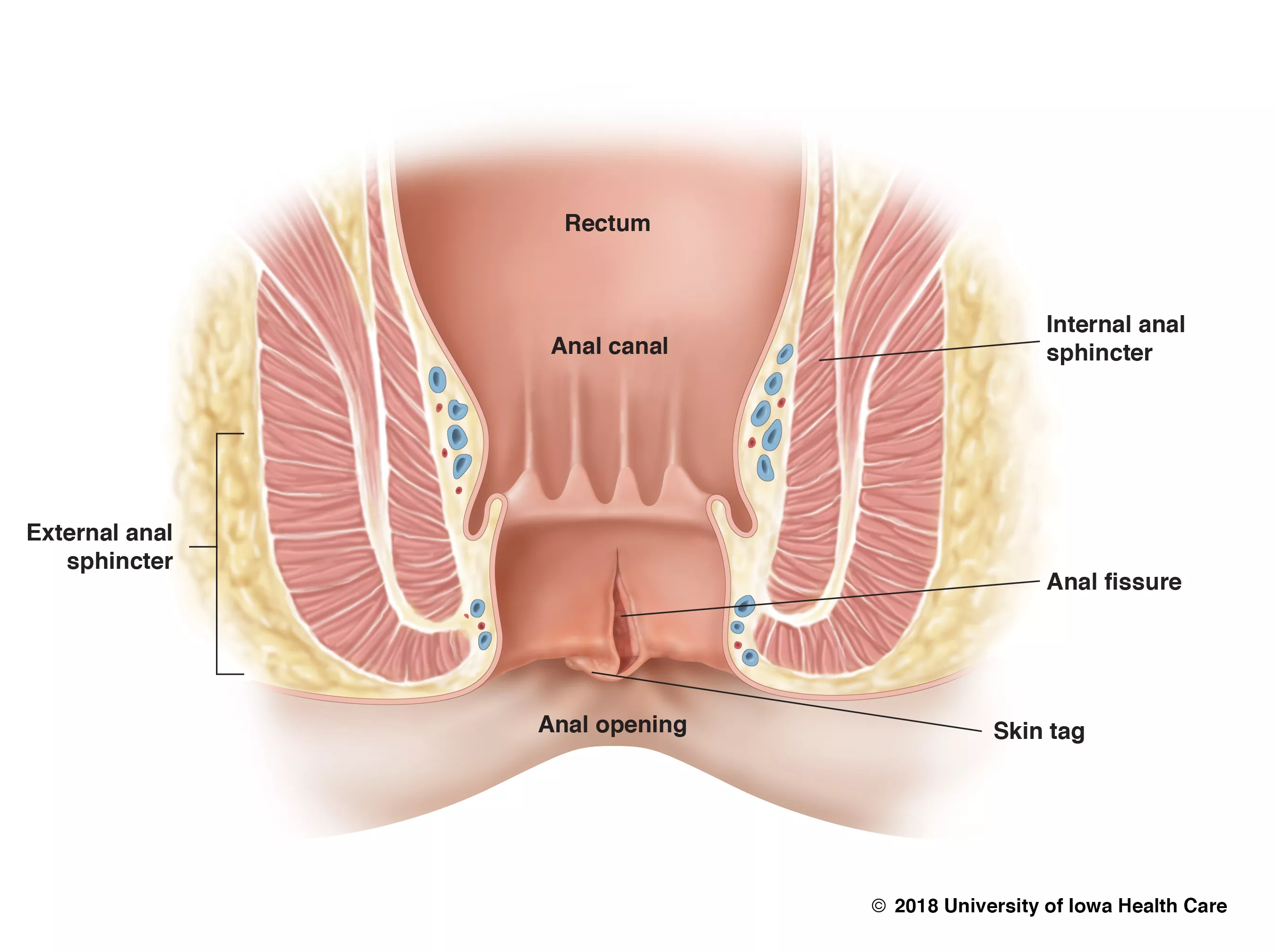 Illustration of an anal fissure