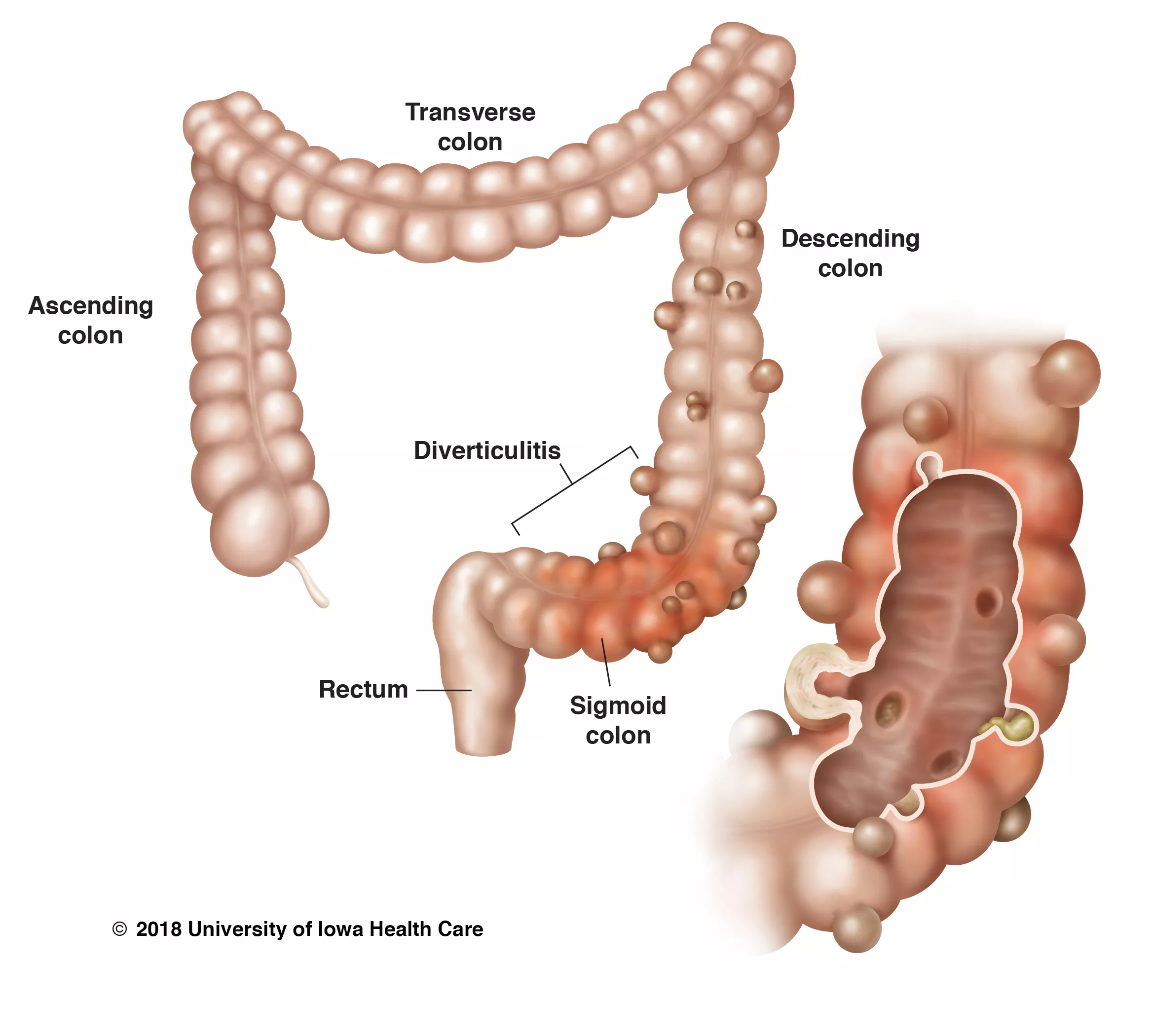 Diverticular disease of the colon University of Iowa Hospitals & Clinics