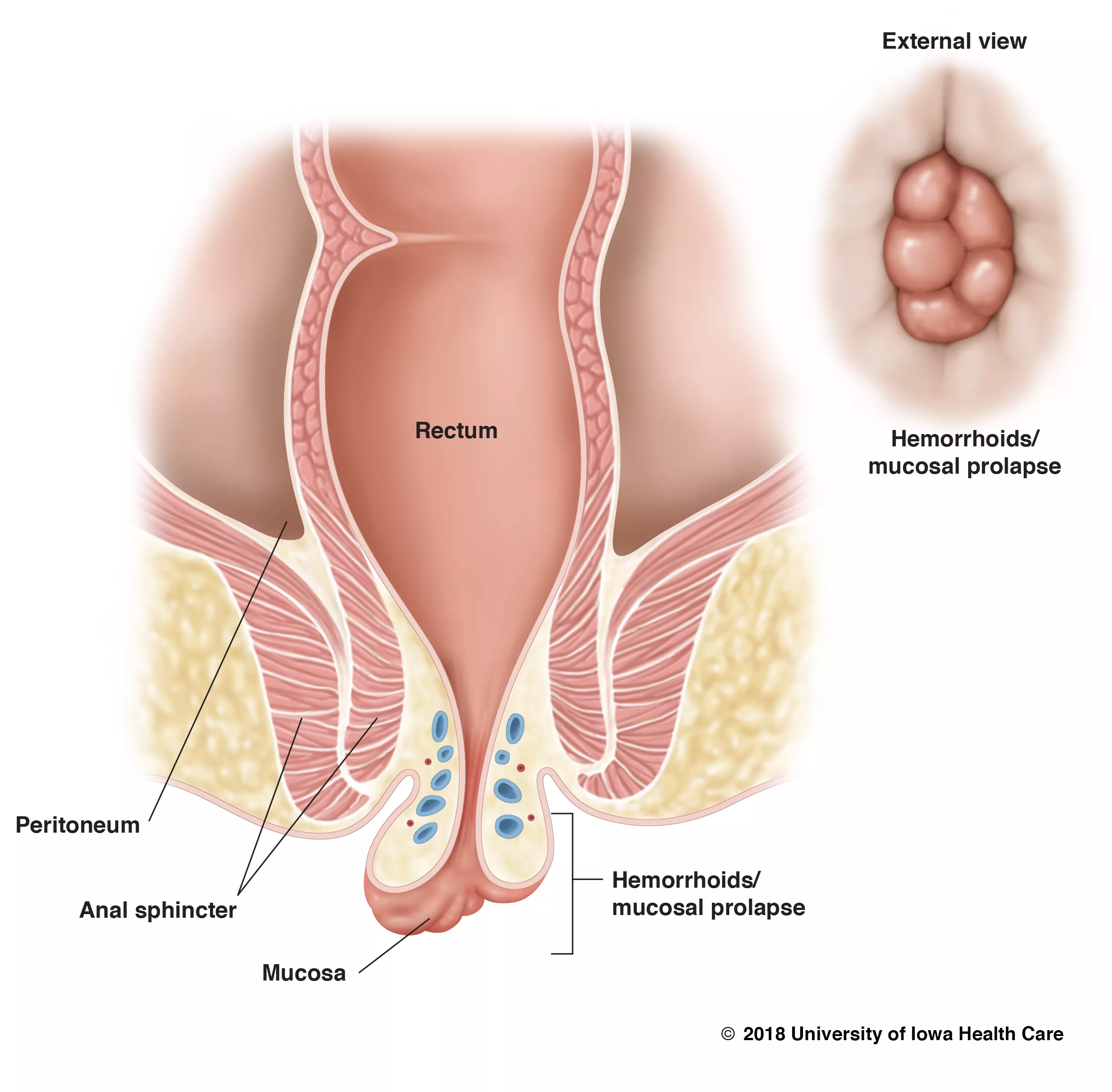 illustration of partial rectal prolapse