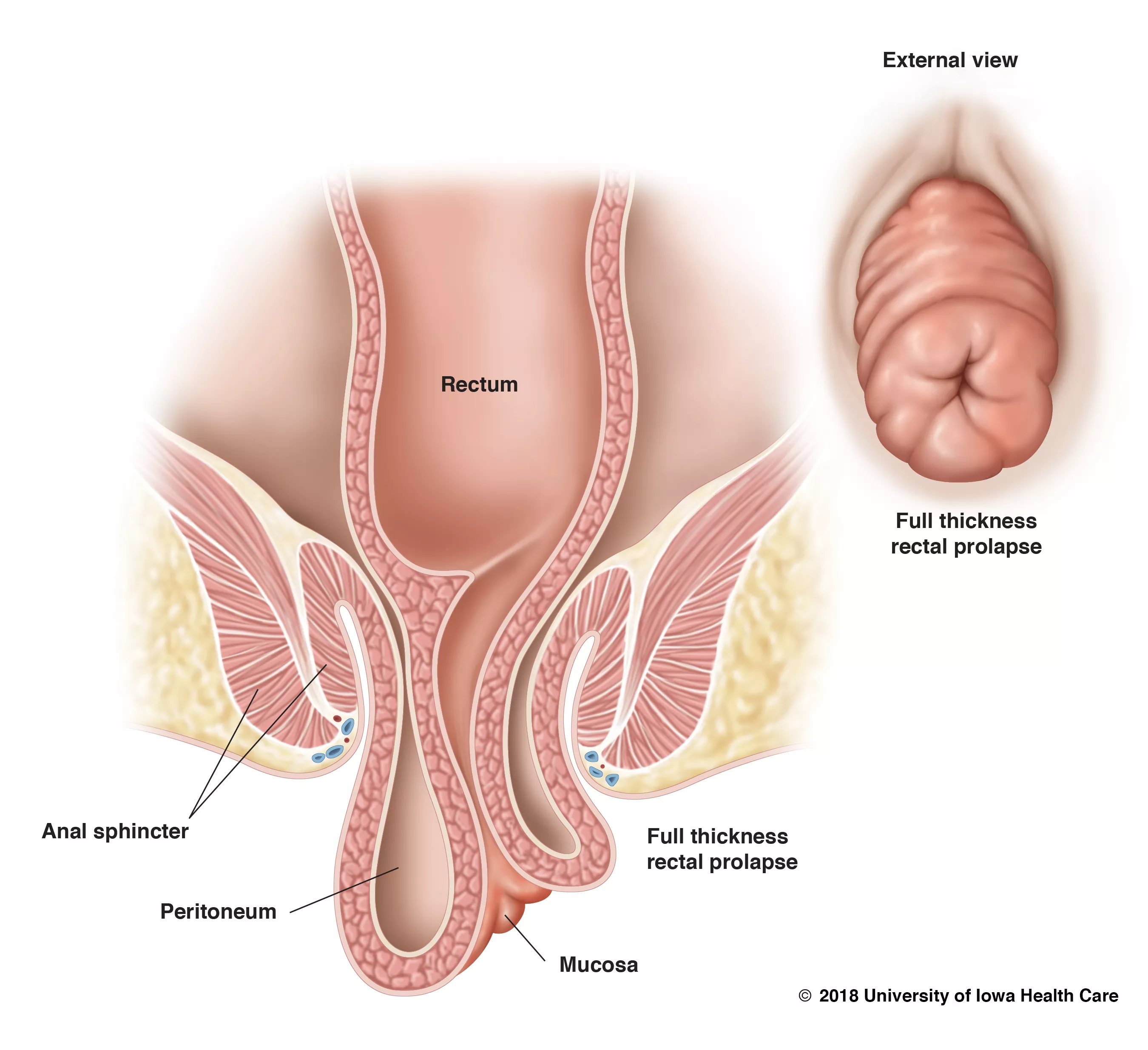 illustration of rectal prolapse