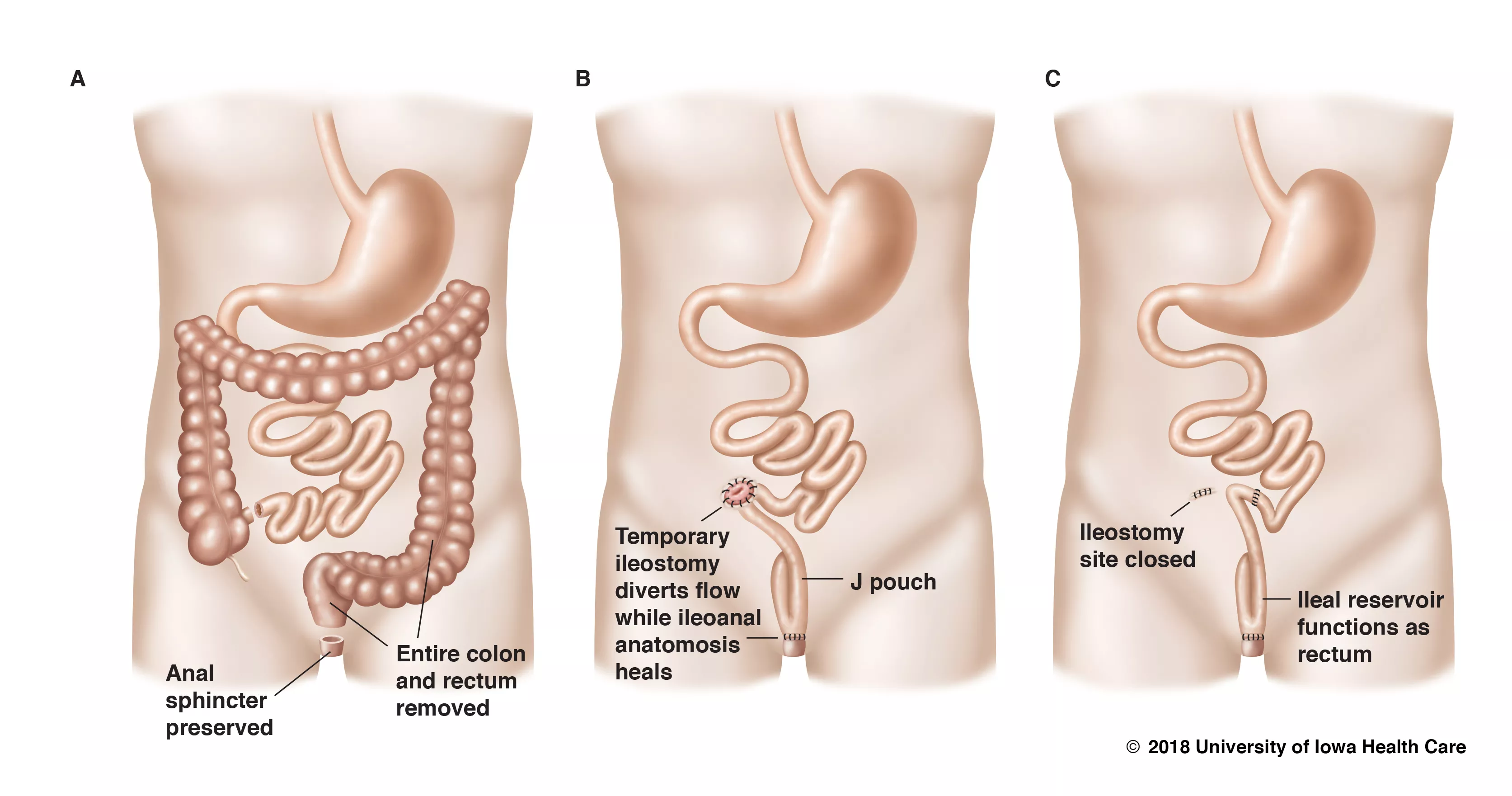 illustrations showing steps in removing colon