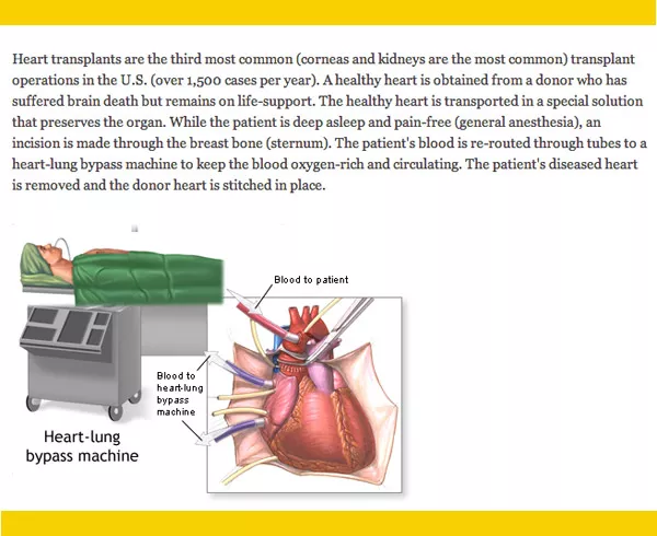 Drawing of a patient receiving a new heart