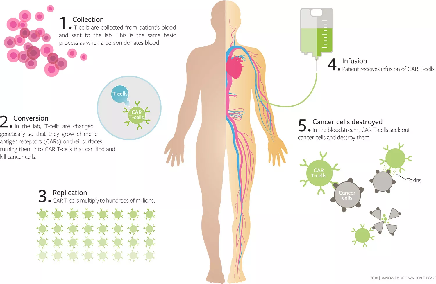 Illustration showing CAR T-cell Therapy procedure