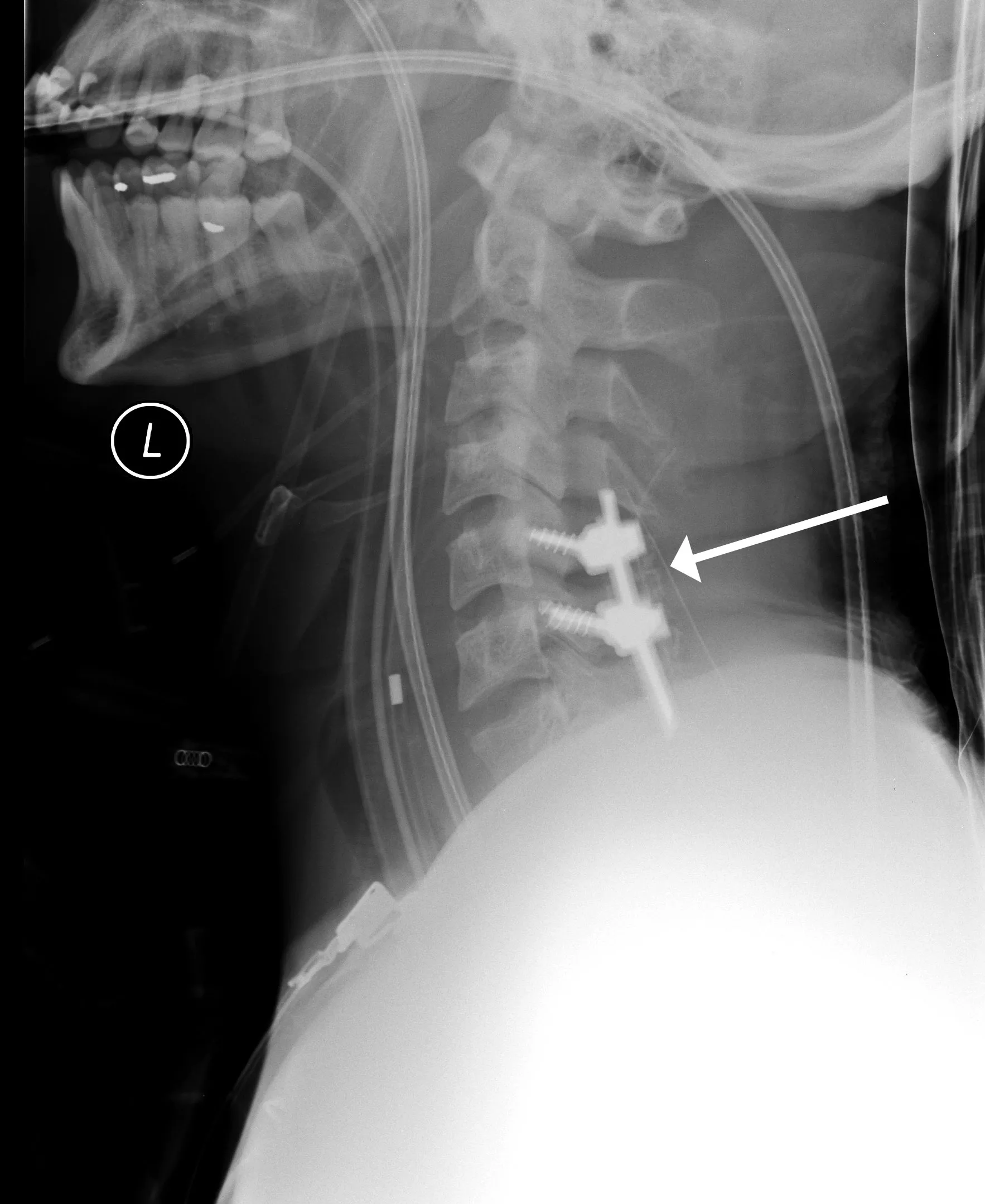 X-ray side view of neck with rods and screws (cervical spine)