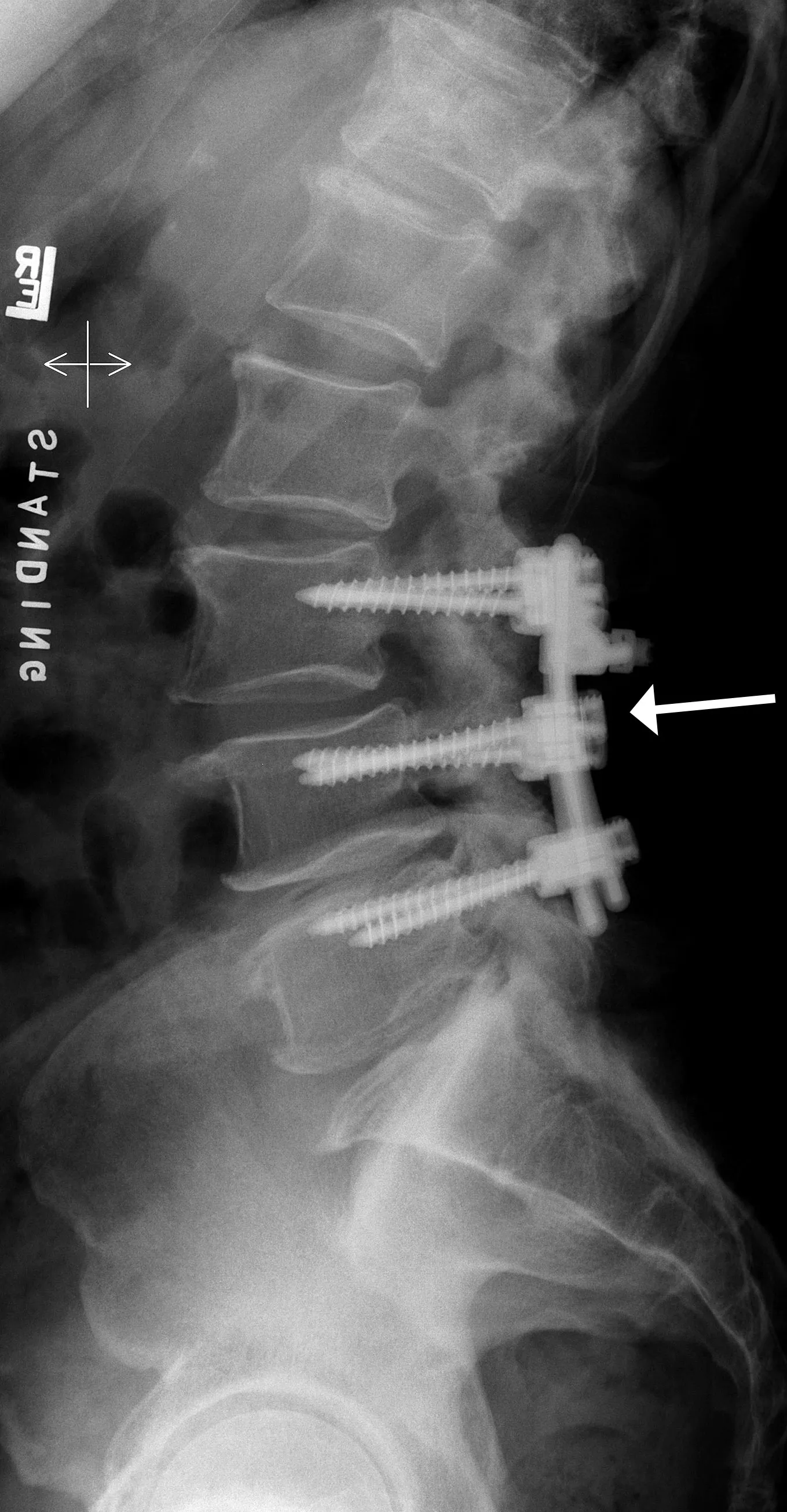 X-ray side view of low back with rods and screws (lumbar spine)