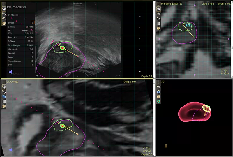 MRI ultrasound fusion biopsy for prostate cancer