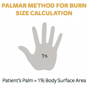 Palmar method for burn size calculation diagram