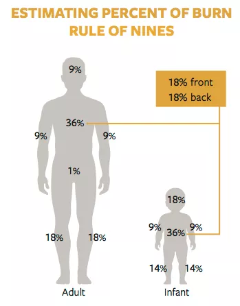 Estimating percent of burn rule of nines diagram