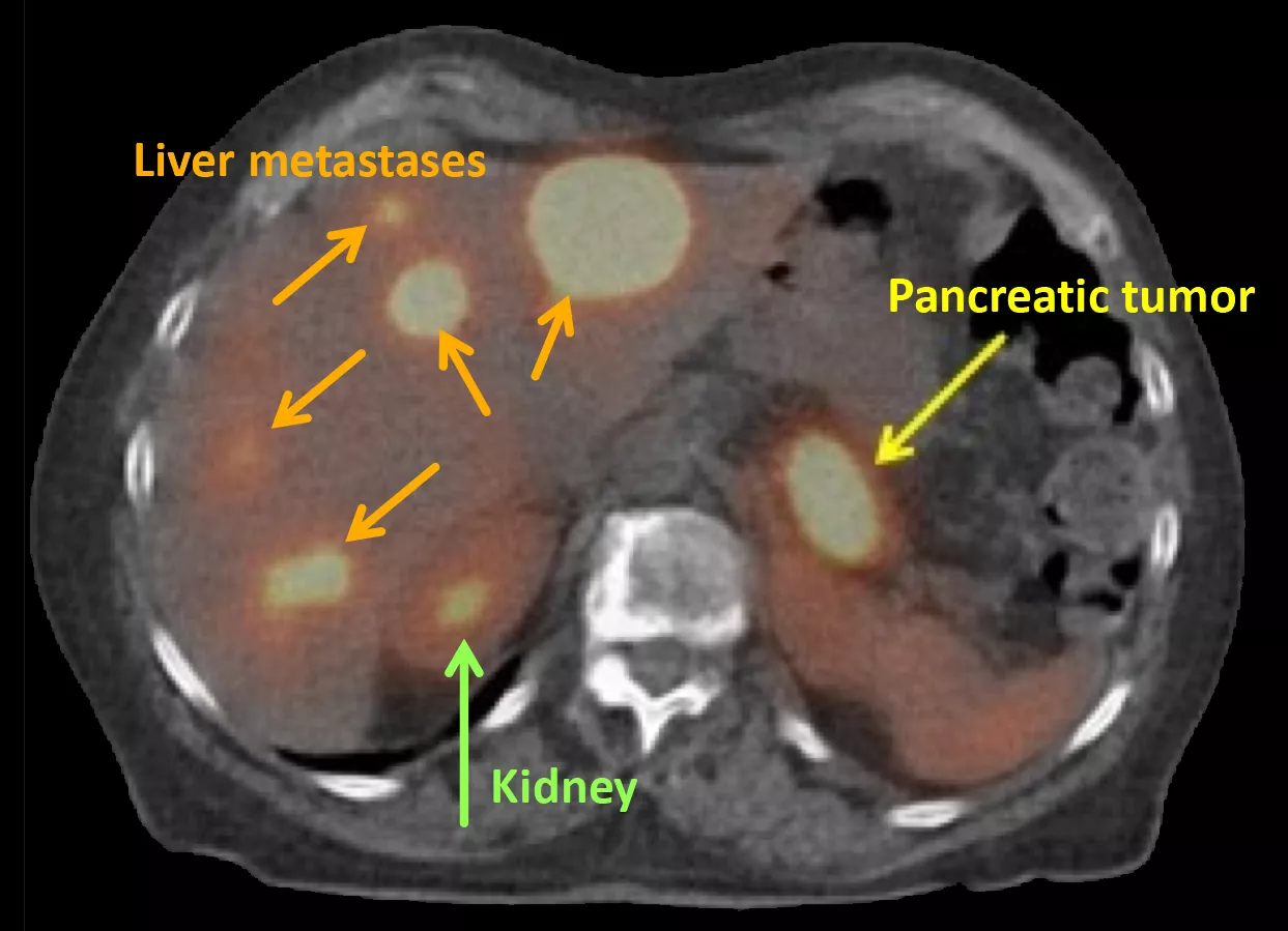 Medical scan showing pancreatic tumor, kidney, and liver metastases