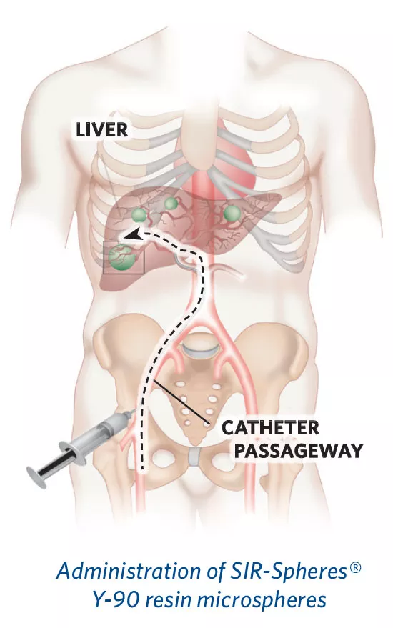 Y90 Radioembolization for Liver Tumors | University of Iowa Hospitals &  Clinics