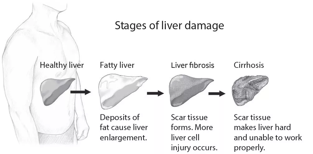 Stages of liver damage include healthy liver, fatty liver, liver fibrosis, and cirrhosis
