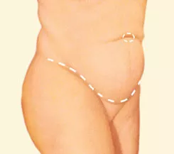 Tummy tuck