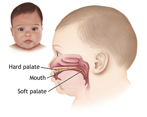 Cleft Palate Diagram